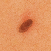 Skintag right after treatment