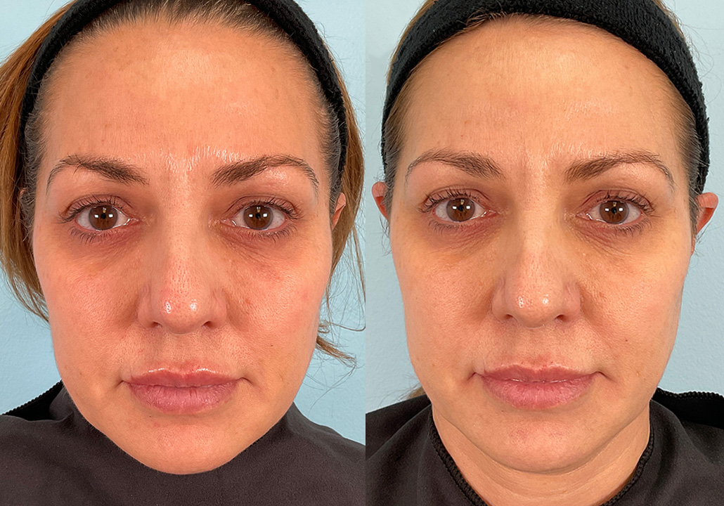 OX STUDY - Subject 002.b