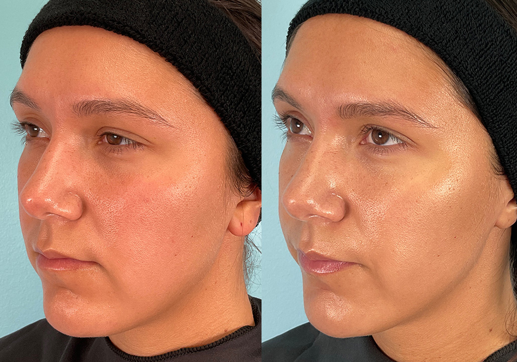 OX STUDY - Subject 004.a