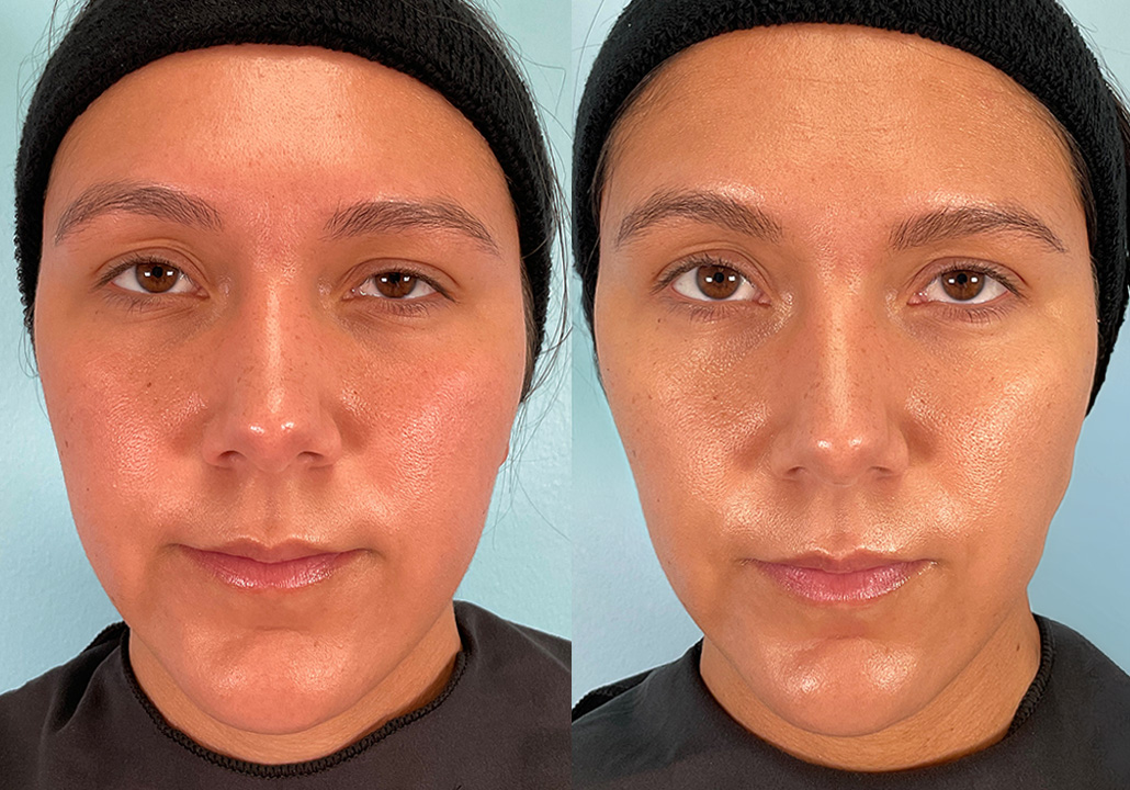 OX STUDY - Subject 004.b