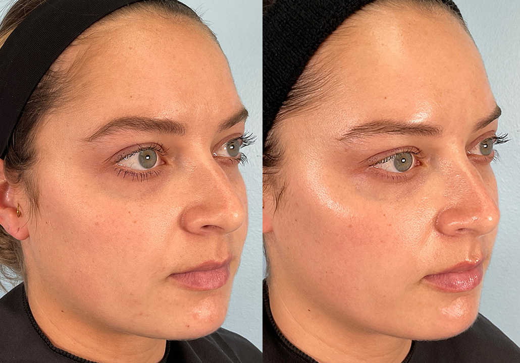 OX STUDY - Subject 007