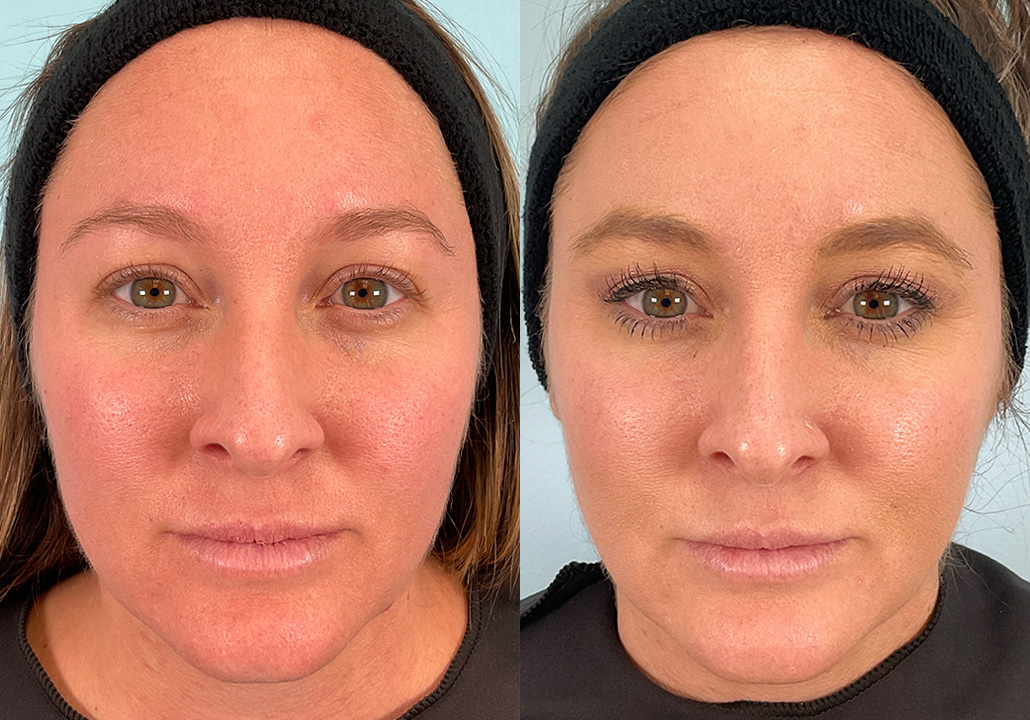 OX STUDY - Subject 014.b