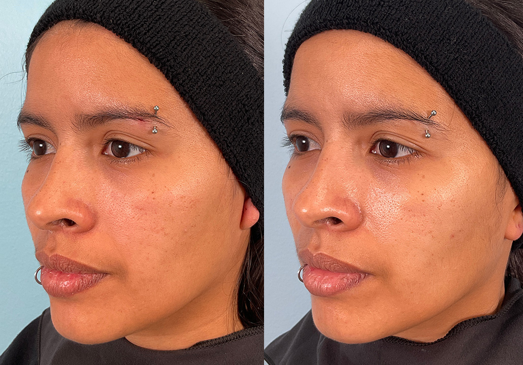 OX STUDY - Subject 019.a