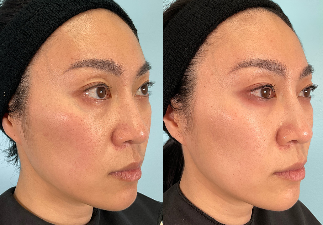 OX STUDY - Subject 030.b