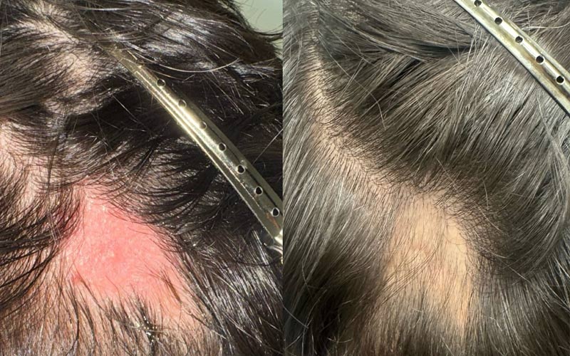 aloepecia-treatment-canada
