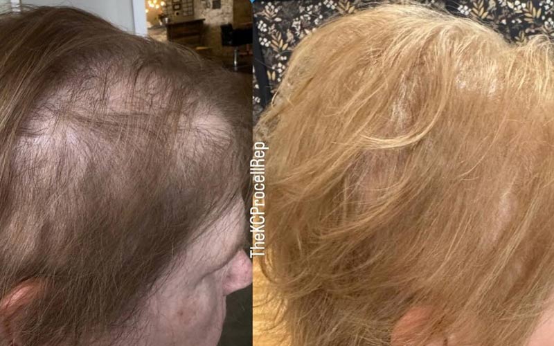procell-therapies-before-and-after-results-hair-regrowth-female