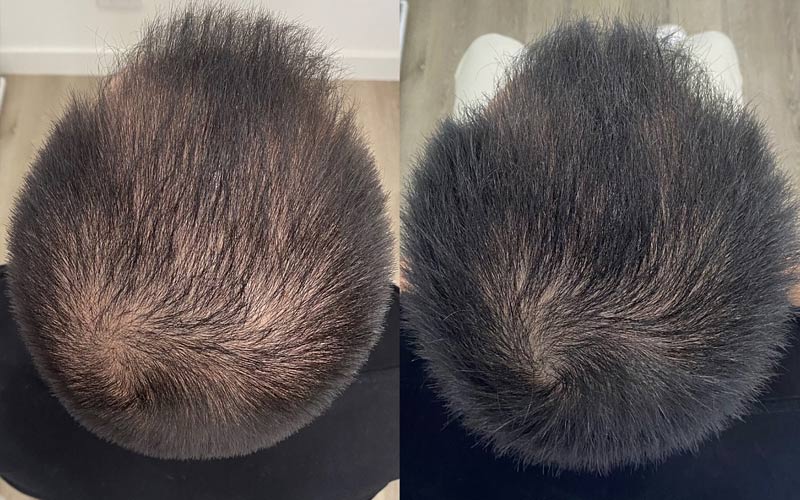 procell-therapies-before-and-after-results-hair-regrowth-men