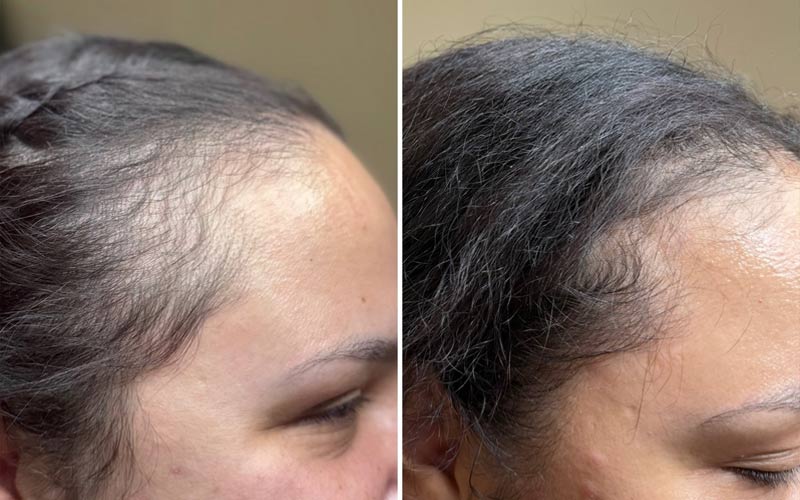 procell-therapies-before-and-after-results-hair-regrowth-women