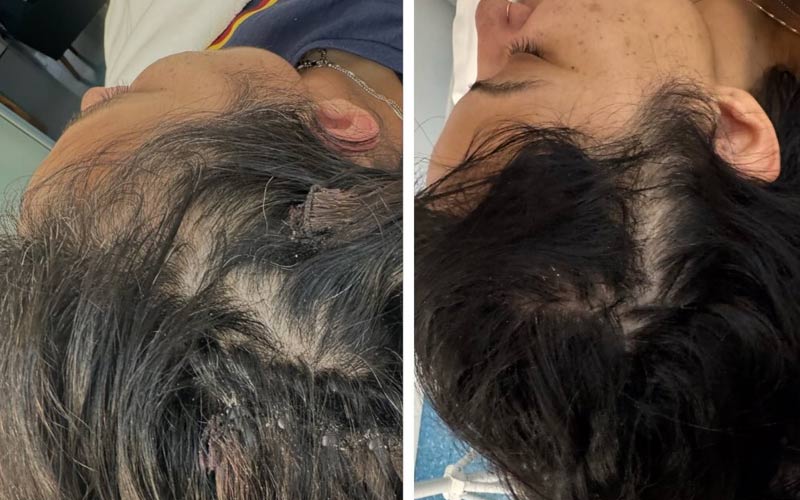 procell-therapies-before-and-after-results-hair-regrowth